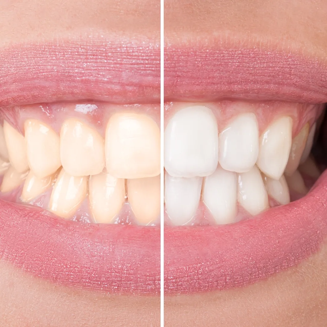 professional teeth whitening Hamilton ON