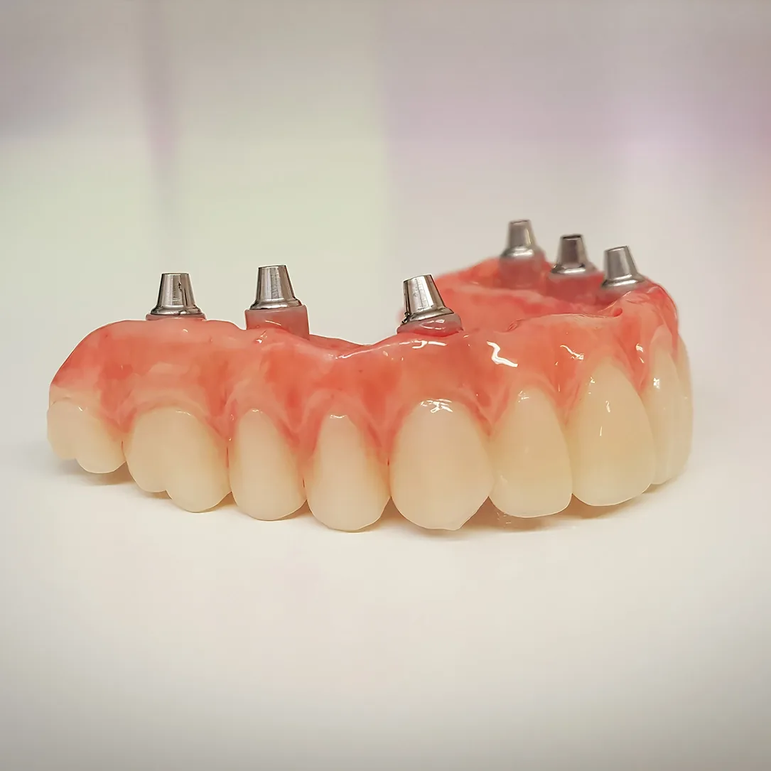 Implant-Secured Dentures