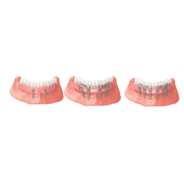 Implant-Secured Dentures