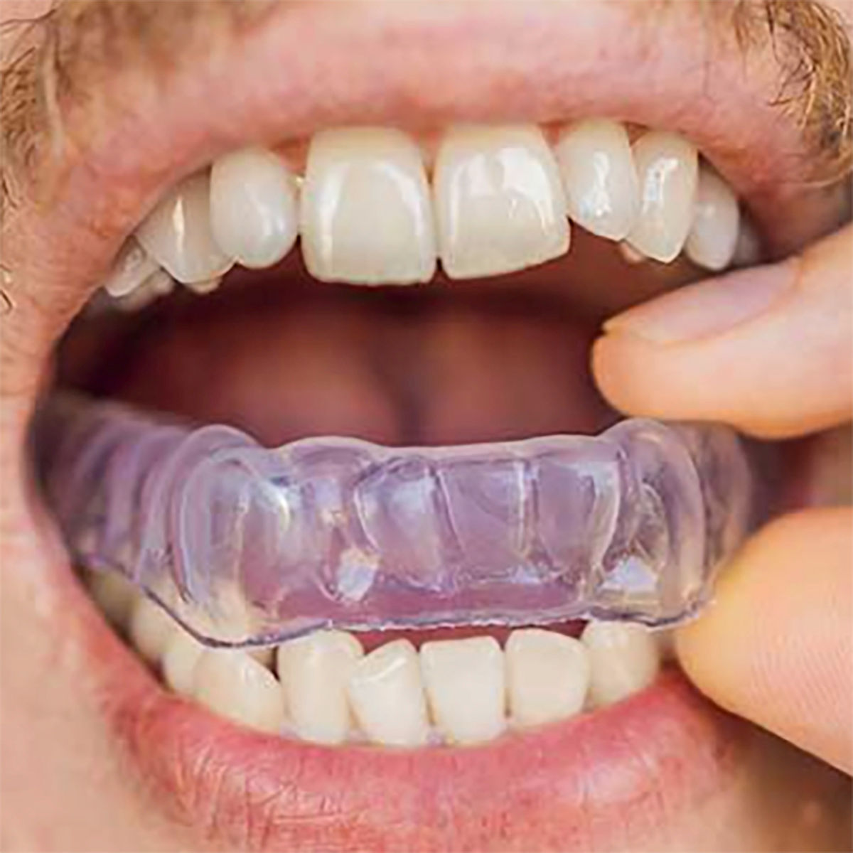 professional mouth guard